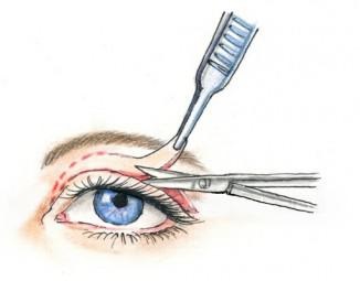 ptozei capacului superior cauze, tratament fara stredstv popular chirurgie, rating, după botox în (operare) ptoza pleoapei superioare cauze, tratament fara chirurgie, stredstv populară comentarii, după Botox în