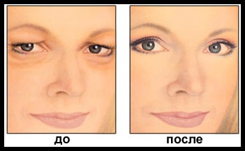 ptozei capacului superior cauze, tratament fara stredstv popular chirurgie, evaluări, după botox în (sus) ptoza pleoapei superioare cauze, tratament fara chirurgie, stredstv populară comentarii, după Botox în