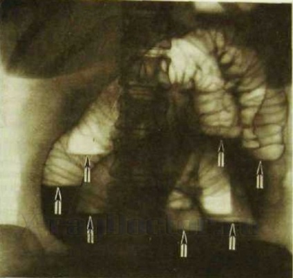 Abdominale raze X cu preparat de bariu, cum și când să facă - Informații referitoare la sănătate (bariu) Abdominale raze X cu preparat de bariu, cum și când să facă - Sănătate Info