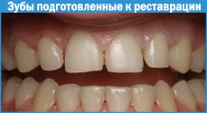 Fotopolimer restaurare de dinti 1 (înconjoară umpluturilor fotopolimeri) fotopolimer restaurare de dinti 1
