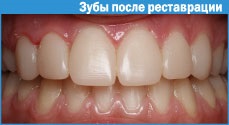 Fotopolimer restaurare de dinti 1 (înconjoară umpluturilor fotopolimeri) fotopolimer restaurare de dinti 1