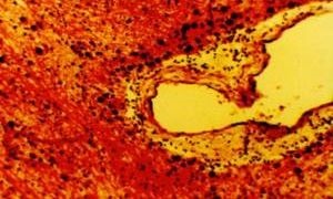 Arnold Chiari Sindromul de tip 1 anomalie, malformații, speranța de viață (Chiari) Arnold Chiari Sindromul de tip 1 anomalie, malformații, speranța de viață