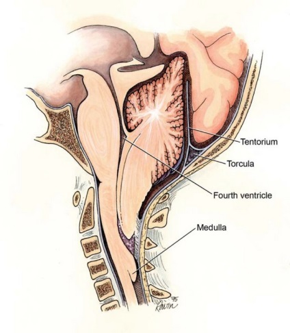 Arnold Chiari Sindromul de tip 1 anomalie, malformații, speranța de viață (Chiari) Arnold Chiari Sindromul de tip 1 anomalie, malformații, speranța de viață