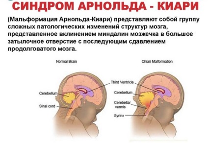 Arnold Chiari Sindromul de tip 1 anomalie, malformații, speranța de viață (de tip) Arnold Chiari Sindromul de tip 1 anomalie, malformații, speranța de viață