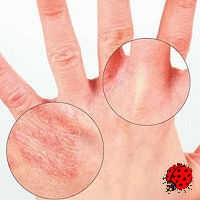 Rash-ul pe mâini (aspect) Rashes pe mâini