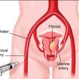 Sfaturi cum să dea naștere - bisturiu - informații medicale și portalul educațional (dreptul de consiliere pentru a da naștere) Sfaturi cu privire la modul de a da naștere dreapta - bisturiu - informații medicale și portal educațional