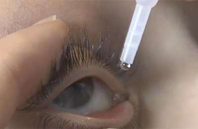 Методи за лечение на синдром на сухото око