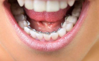 Nu acolade pus (a pune) Fie pentru a pune aparat dentar