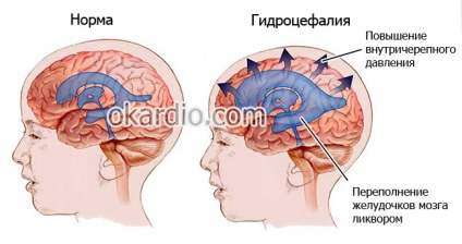 hemoragie subarahnoidiană, care este, cauze, tratament, consecinte (cauza) hemoragie subarahnoidiană, care este, cauze, tratament, consecințe