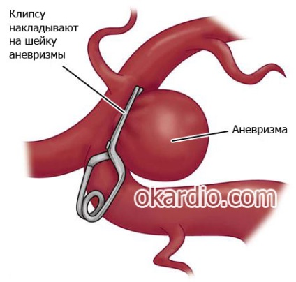 hemoragie subarahnoidiană, care este, cauze, tratament, consecinte (hemoragie) hemoragie subarahnoidiană, care este, cauze, tratament, consecințe