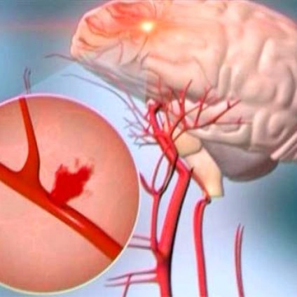 Tipuri de subarahnoidiană hemoragie, cauze, simptome, diagnostic, tratament, (aspect) Tipuri de hemoragie subarahnoidiană, cauze, simptome, diagnostic, tratament,