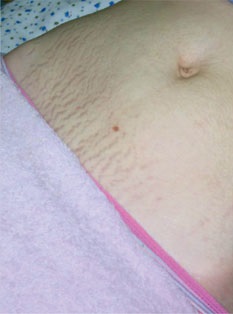 Eliminarea vergeturi, cicatrici si cicatrici Yekaterinburg - cosmetice si magnolie Clinica Ginecologie - (indepartarea extensiilor) Eliminarea vergeturi, cicatrici, cicatrici în Yekaterinburg - Clinica cosmetologie de Ginecologie si magnolie -