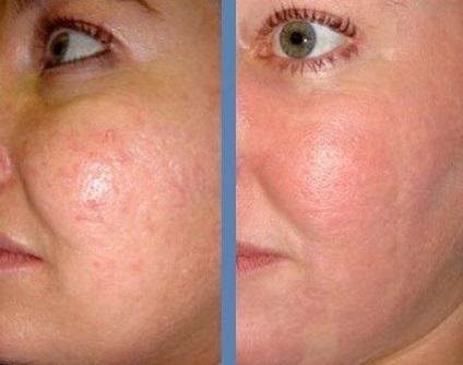 Melc Achatina în comentarii cosmetologie (modul de utilizare) (melc) Melc Achatina în comentarii cosmetologie (modul de utilizare)