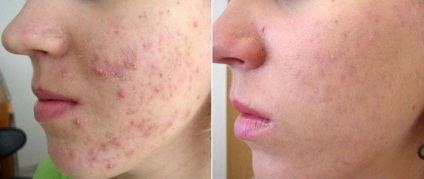 Melc Achatina în comentarii cosmetologie (modul de utilizare) (review-uri) Melc Achatina în comentarii cosmetologie (modul de utilizare)