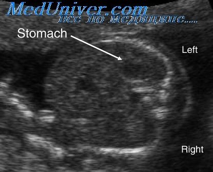 Uzi colon fetal (mare) fat de colon Uzi