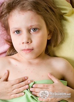 Varicela la copii tratați (tratamentul modern al varicela la copii) Varicela la copii tratați