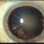 aftercataract