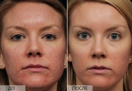 Hilak forte pentru peeling facial, comentarii Porții aplicare hylak (peeling) forte Hilak pentru peeling facial, comentarii Porții cerere hylak