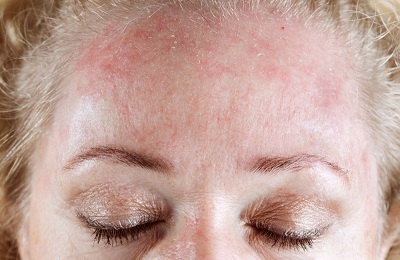 Dermatita tratament rece pe mâini și a feței (dermatită) Tratamentul la rece dermatitei la nivelul mâinilor și feței