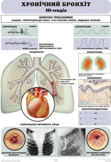 Clinica bronșită cronică - doamna citytile (bronșită) Clinica bronșită cronică - doamna citytile