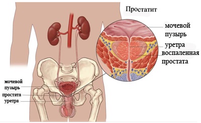 Do prostatita este contagioasă (prevenirea generală anatomică imposibilă) Do prostatita este contagioasă