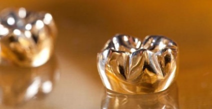 Dinte de aur (dinte) aur dentar