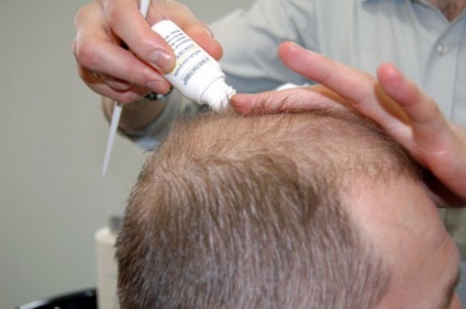 scalpului si pierderea parului cauze si tratament (seboreica pierderea parului seboree matreata gras senzația de mâncărime scalp lupta cura) Mancarimea scalpului si caderea parului cauze si tratament Mancarimea