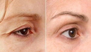 Blefaroplastia Ufa - clinica viromed