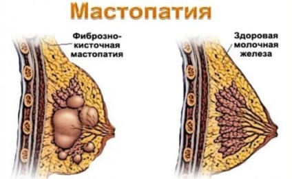 Ce este fibro boala de san chistică și modul în care este periculos