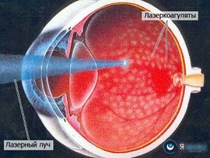 coagulare cu laser a efectelor retinei contra-ochi, pret, comentarii, foto, video