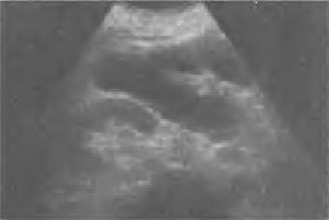 obstrucție intestinală acută (abdomen simplu de film) obstrucție intestinală acută