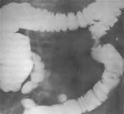 ocluzie intestinală acută (film simplu abdominal) obstrucție intestinală acută