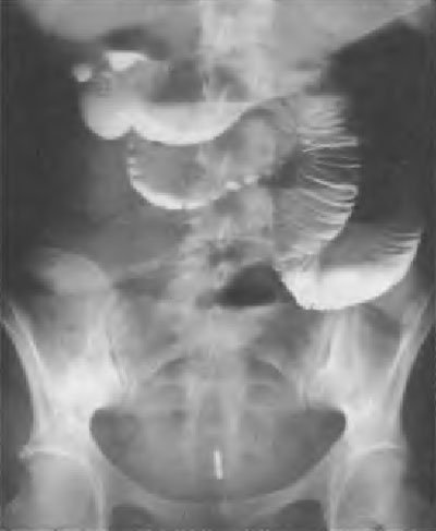 obstrucție intestinală acută (boala Crohn) obstrucție intestinală acută