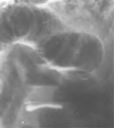 ocluzie intestinală acută (boala peritoneală adeziv) obstrucție intestinală acută