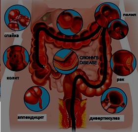 Tot ce trebuie sa stiti despre o colonoscopie - Centrul Medical Primamedia