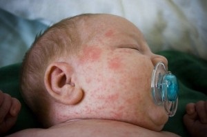 Alergia la „frisopep“ alergie (suferă reacții alergice) Alergia la „frisopep“ alergie