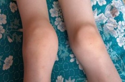 Osteoartrita a genunchiului - Diagnostic si Tratament (genunchi) Osteoartrita a genunchiului - Diagnostic si Tratament