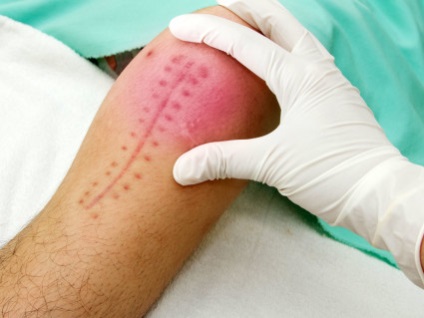 Osteoartrita a genunchiului - diagnostic si tratament (artroza) Osteoartrita a genunchiului - Diagnostic si Tratament