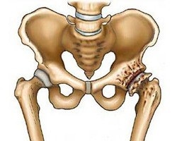 Osteoartrita tratamentului grad șold 3 (comun) sold artroze gradul 3 de tratament