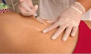 Fără a ascensorului abdominale (suprafețele laterale burtă) O abdominoplastie non-chirurgicale