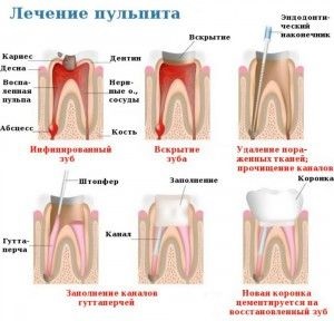 Mă doare dacă pentru a șterge un nerv dintr-un dinte după arsenic (bolnav) Mă doare dacă pentru a șterge un nerv dintr-un dinte după arsenic