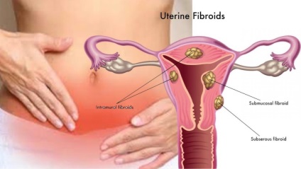 Ceea ce este diferit de fibrom fibrom uterin (miom) Ceea ce este diferit de fibrom fibrom uterin