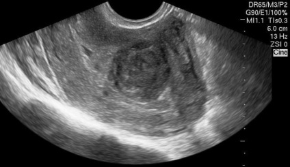 Ceea ce este diferit de fibrom fibrom uterin (miom) Ceea ce este diferit de fibrom fibrom uterin