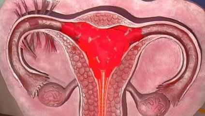 Ceea ce este diferit de fibrom uterin ale uterului (uter) Ceea ce este diferit de fibrom fibrom uterin