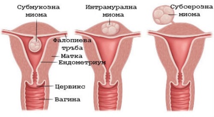 Ceea ce este diferit de fibrom uterin (fibrom diferite) Ceea ce este diferit de fibrom fibrom uterin
