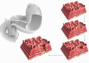 Tu elimina durerea ulcerului gastric și duodenal (inflamat) Tu elimina durerea de ulcer gastric și ulcer duodenal