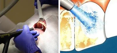 Periajul dintilor cu un dentist plusuri și minusuri profesionale de curatenie (plusuri) Spalatul pe dinti la dentist pro și contra de curățare profesională