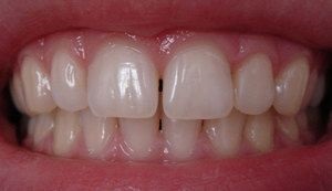 Ce se întâmplă dacă gingiile dureroase, durere eliminarea, de ce apare si cum sa aiba grija de gingiilor, (de ce) Ce se întâmplă dacă gingiile dureroase, durere eliminarea, de ce apare și cum să aibă grijă de gingiilor,