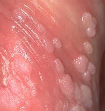 Ce este un papilloma și cum arată (papilomavirus uman) Ce este un papilloma și cum arată