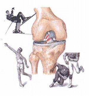 Care sunt cauzele simptomelor de instabilitate a genunchiului, tratamentul (tratamentul genunchiului instabilitatea articulațiilor) Care sunt cauzele simptome de instabilitate genunchi, tratament